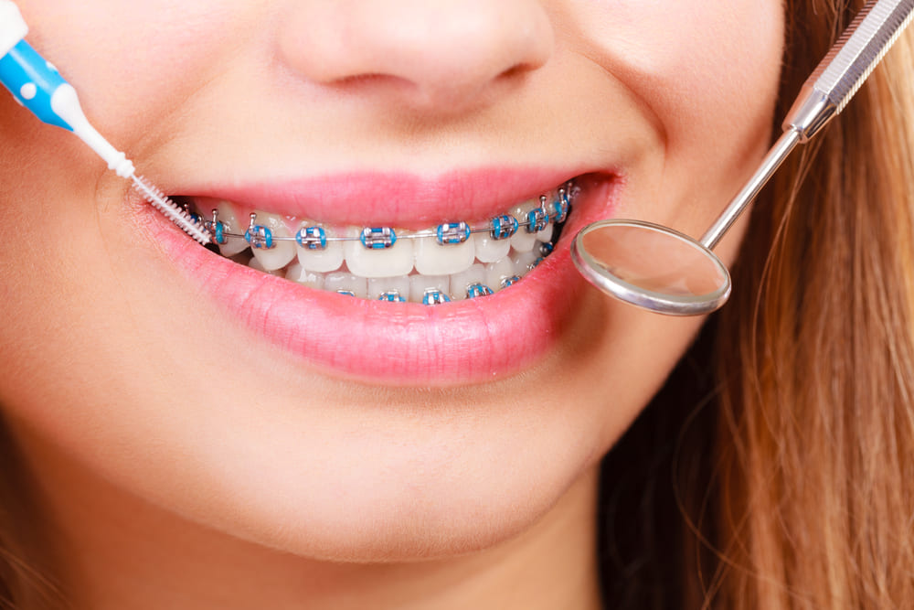 Cleaning dental braces