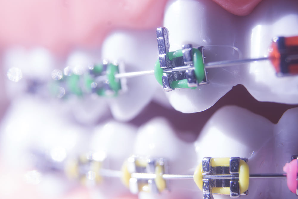 The Challenges of Metal Braces